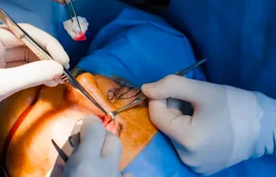 Czy korekcja powiek jest bezpieczna? Fakty i mity o zabiegu